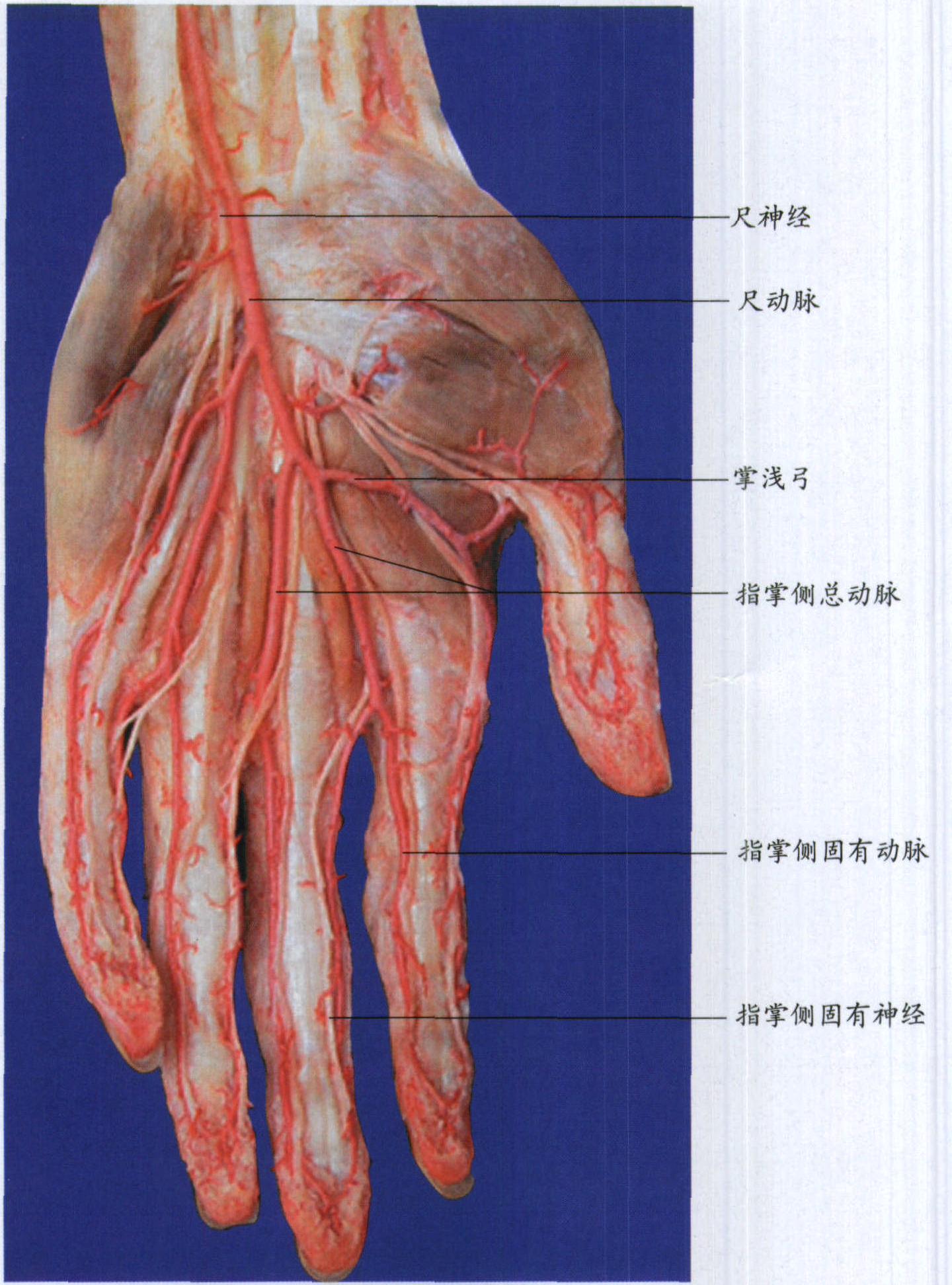 图6-32 掌浅弓(尺动脉型)